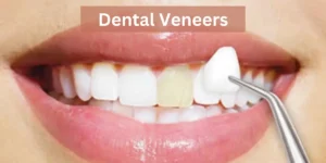 Dental Veneers as Teeth Gap (Diastema) Treatments