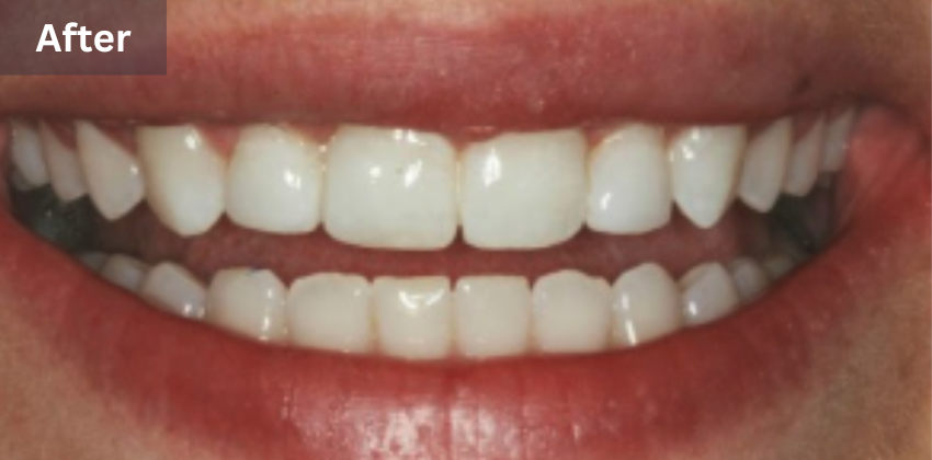 Invisalign before after sunnyvale
