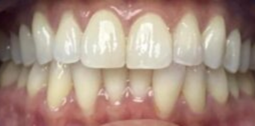 Invisalign-before-after-sunnyvale