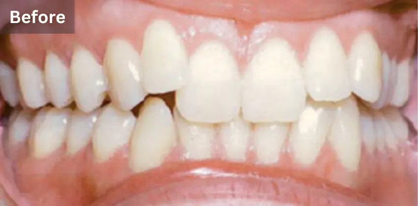 Invisalign before after sunnyvale