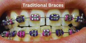 Traditional Braces as Teeth Gap (Diastema) Treatment
