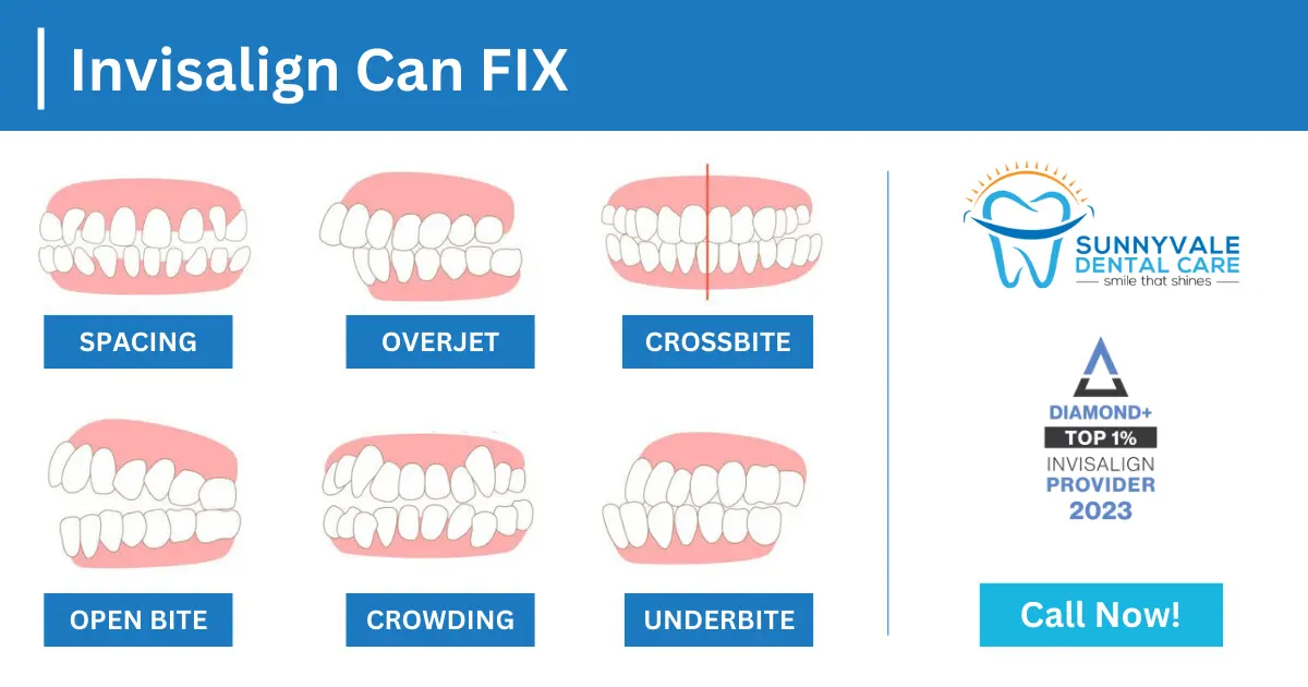 Invisalign Can FIX cross bite, open bite, spacing, under bite, overjet and crownding