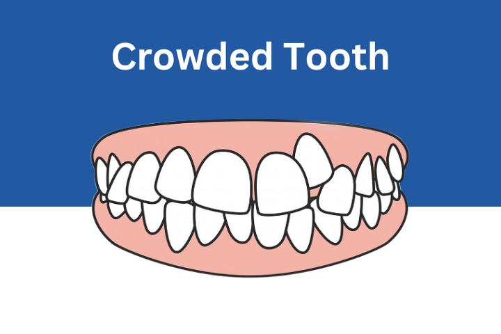 Crowded Tooth
