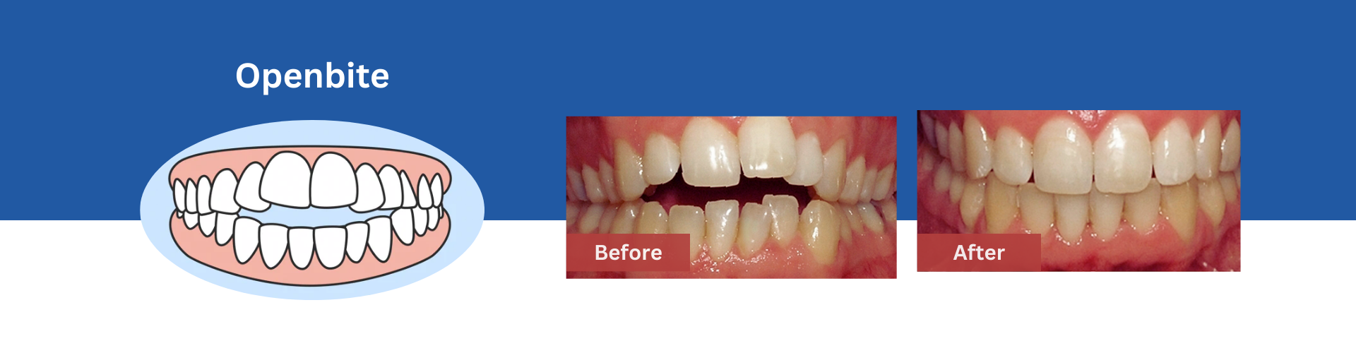 Openbite-Teeth-Treatment-Sunnyvale