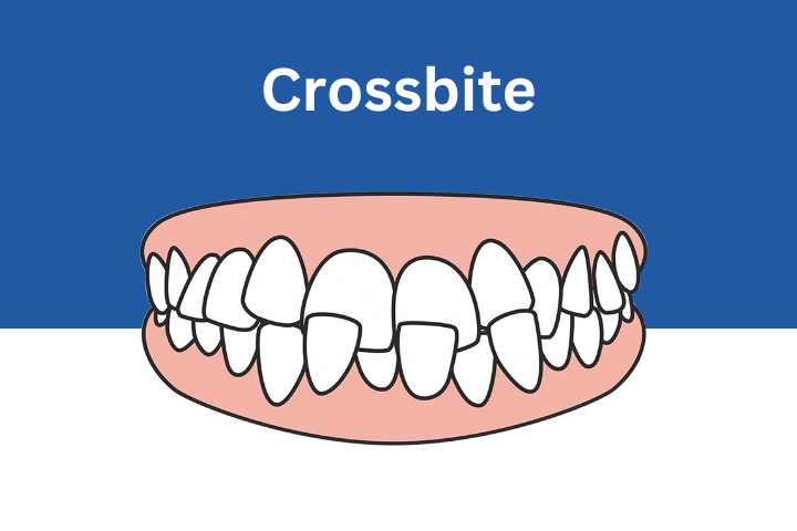 invisalign-can-fix-crossbite