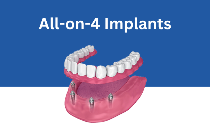 All-on-4-Implants Sunnyvale