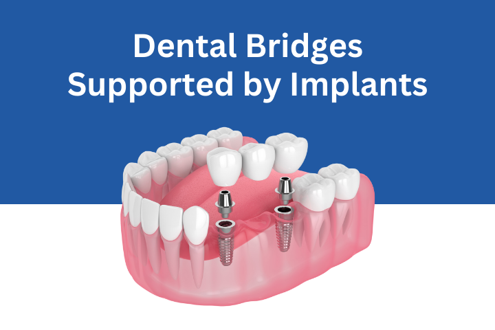 Dental-Bridges-Supported-by-Implants Sunnyvale
