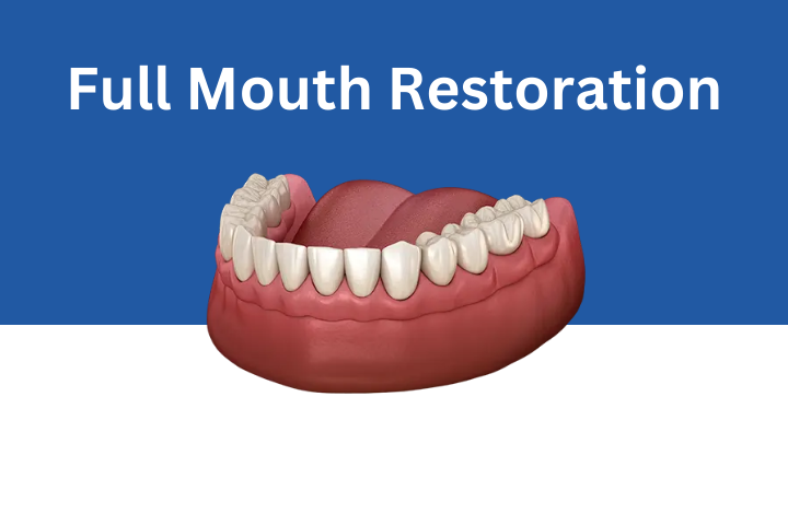 Full-Mouth-Restoration Sunnyvale