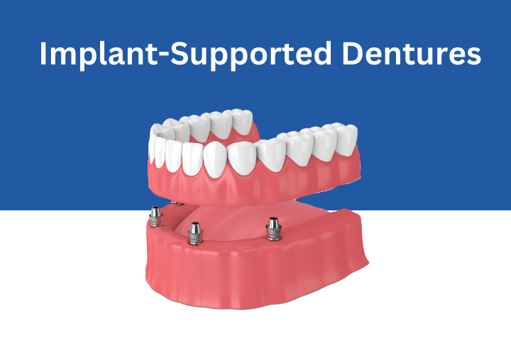 Implant-Supported-Dentures Sunnyvale