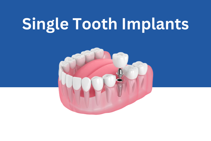 Single-Tooth-Implants Sunnyvale