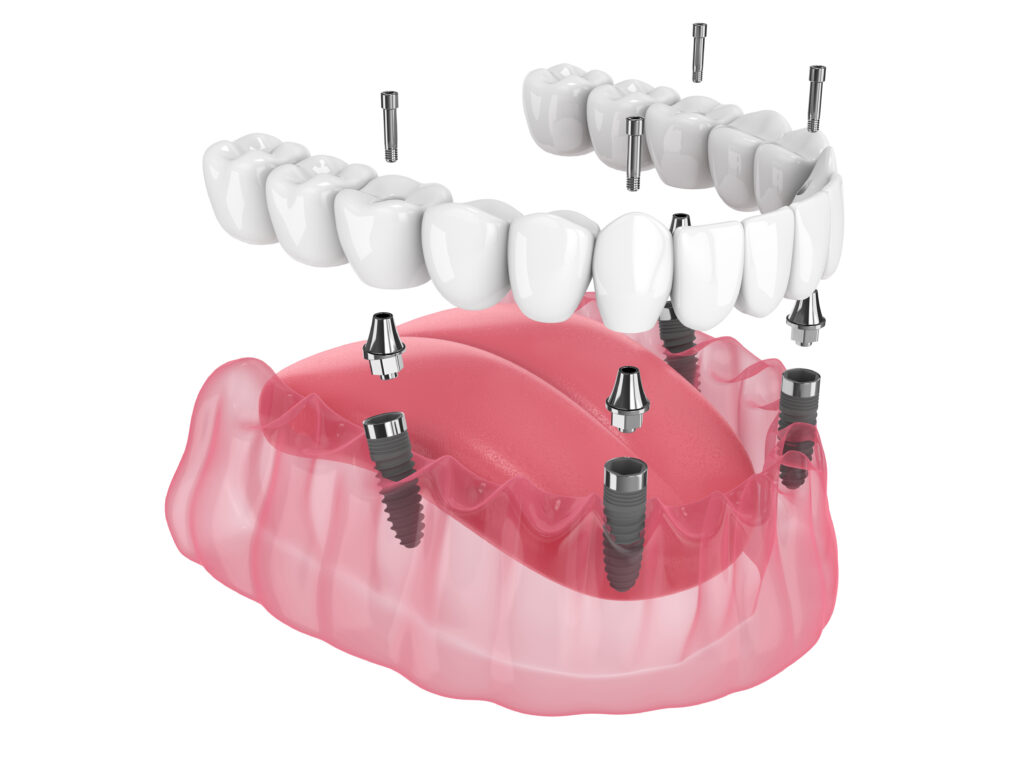 Will All-on-4 Dental Implants Affect My Daily Oral Care Routine in Sunnyvale, CA?