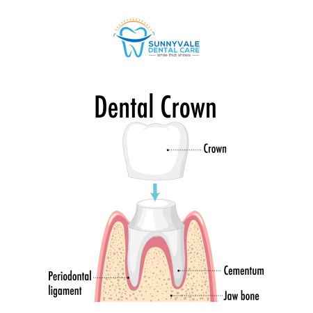 Dental Crown Treatment in Sunnyvale