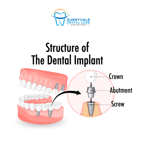 Detnal Implant Treatment in Sunnyvale