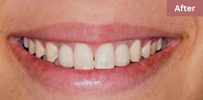 Dental implant Sunnyvale