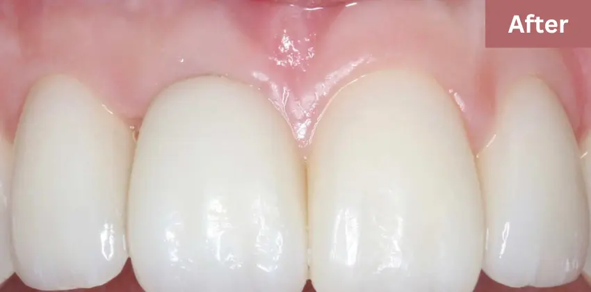 Dental implant Sunnyvale