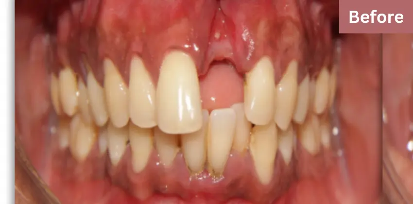 Dental implant Sunnyvale