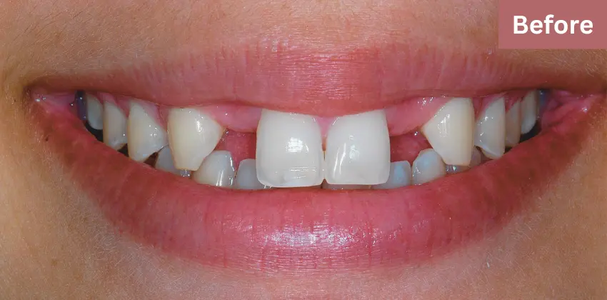 Dental implant Sunnyvale