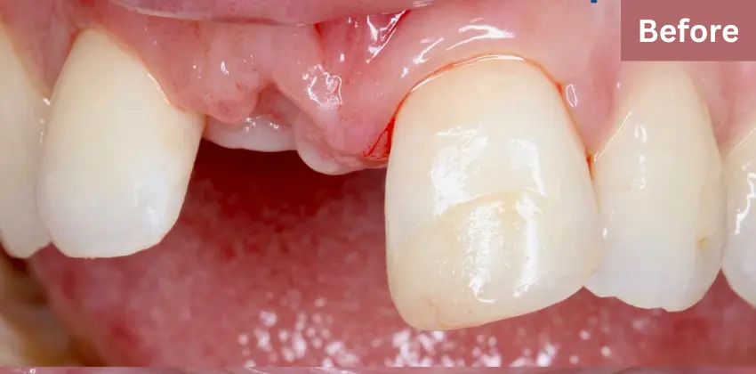 Dental implant Sunnyvale