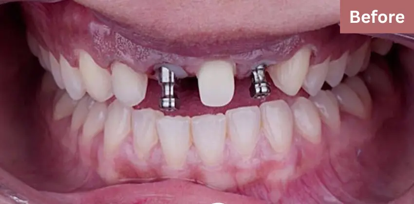 Dental implant Sunnyvale