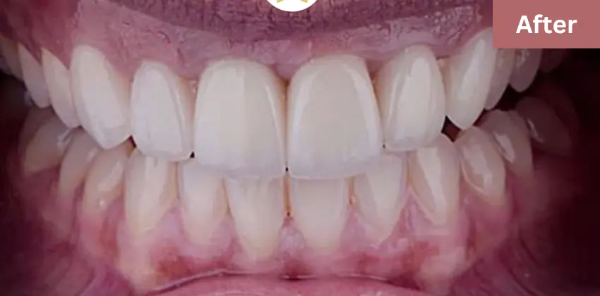 Dental implant Sunnyvale